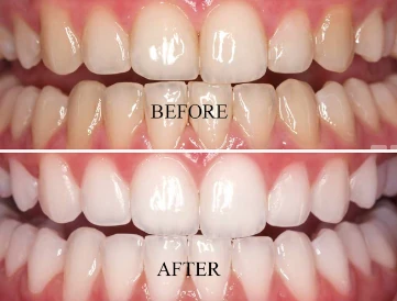 Most of the patients get similar results. Talk to your dentist before the process..